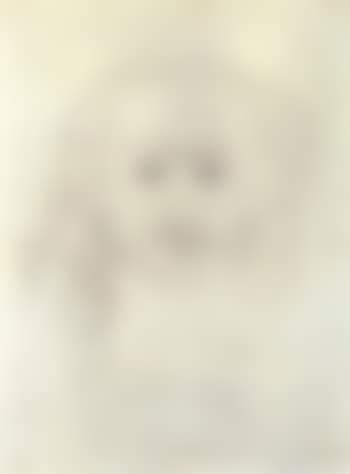 Hirsutism (preview)