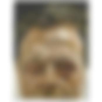 Self-portrait With A Black Eye (preview)